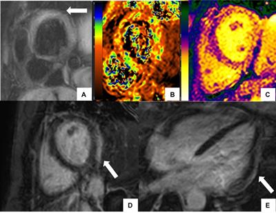 Cardiac magnetic resonance assessment of cardiac involvement in autoimmune diseases